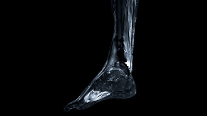 MRI FOOT scan Sagittal view T2 Fat suppression  technique   for diagnostic tendon injury.