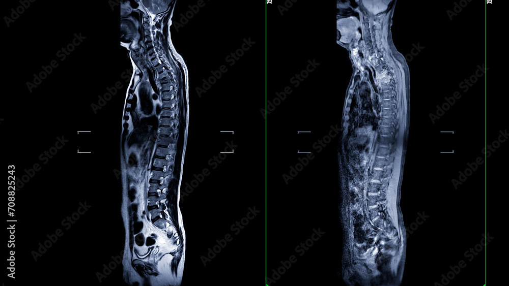 Poster an mri of the whole spine image is a comprehensive visual representation produced through magnetic r