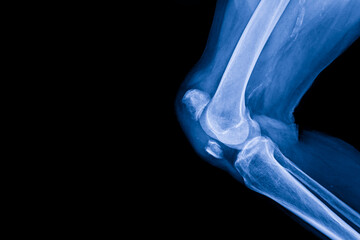 A film x-ray of left knee lateral view shown fracture of knee cap(patella) bone. The plain film of...