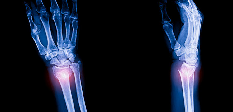 X ray image of distal radius fracture colles fracture. Blue tone radiograph on dark background in hospital.Doctor used xray for diagnosis of illness of patient.AP and lateral view on black background.