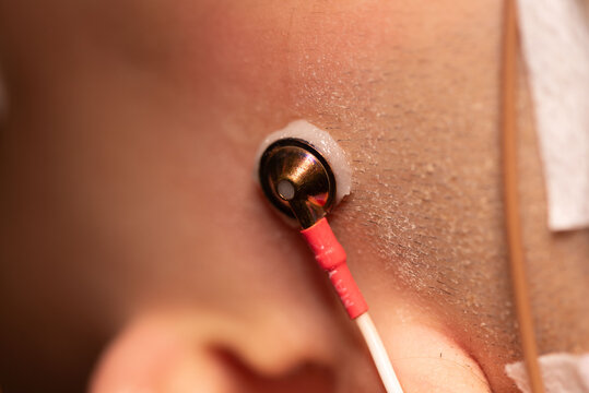 EEG electrode attached on patient scalp 
