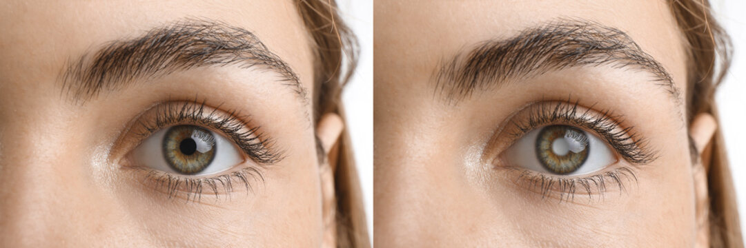 Closeup view of woman before and after glaucoma treatment on white background