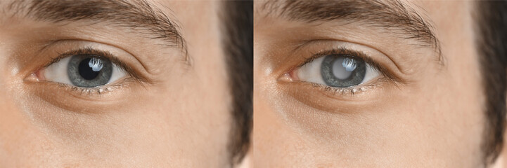 Closeup view of man before and after glaucoma treatment, closeup
