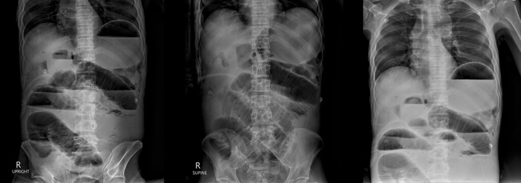 Xray radiograph on dark background in hospital.Doctor used xray for diagnosis of the illness of patient.x-ray of acute abdomen series shown small gut or bowel obstruction.Emergency surgery.Close loop.