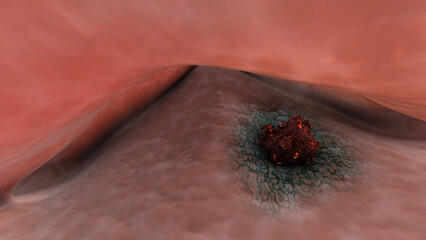 Brachytherapy for cervical cancer or intracavitary brachytherapy