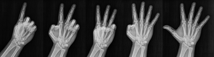 Film xray x-ray or radiograph of a hand and fingers showing the numbers one through five 1-5.  One,...