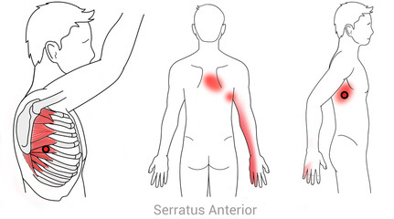 Serratus Anterior: Myofascial trigger points and associated pain locations