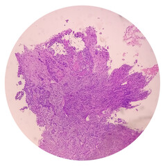 Invasive squamous cell carcinoma of larynx grade 2