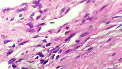 Photomicrograph of histological slide showing Lobular capillary hemangioma on finger.