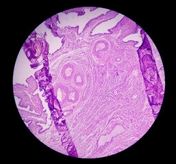 Histopathological photomicrograph of ovarian cyst showing Metastatic cystic teratoma.
