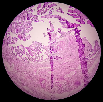 Histopathological photomicrograph of ovarian cyst showing Metastatic cystic teratoma.
