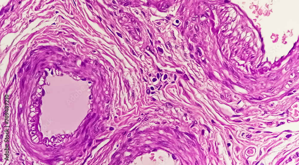 Poster Histopathological photomicrograph of ovarian cyst showing Metastatic cystic teratoma.