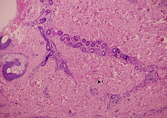 Histological Photomicrograph: Prurigo nodularis (PN) is a chronic disorder of the skin. 