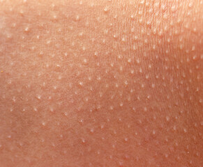 cold rash on the skin as a background.