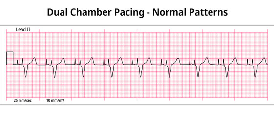 ECG Dual Chamber Pacemaker Rhythm - Normal Pattern - 8 Second ECG Paper - Electrocardiography Vector Medical Illustration