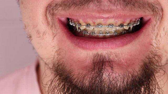 Close-up of a man's mouth showing metal dental braces with special elastic bands. The patient is receiving orthodontic treatment
