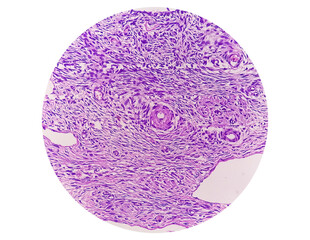 Histology, Peritoneal inclusion cyst. Paraovarian cysts, hydrosalpinx and low-grade cystic...