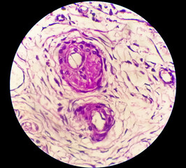 Histology, Peritoneal inclusion cyst. Paraovarian cysts, hydrosalpinx and low-grade cystic...