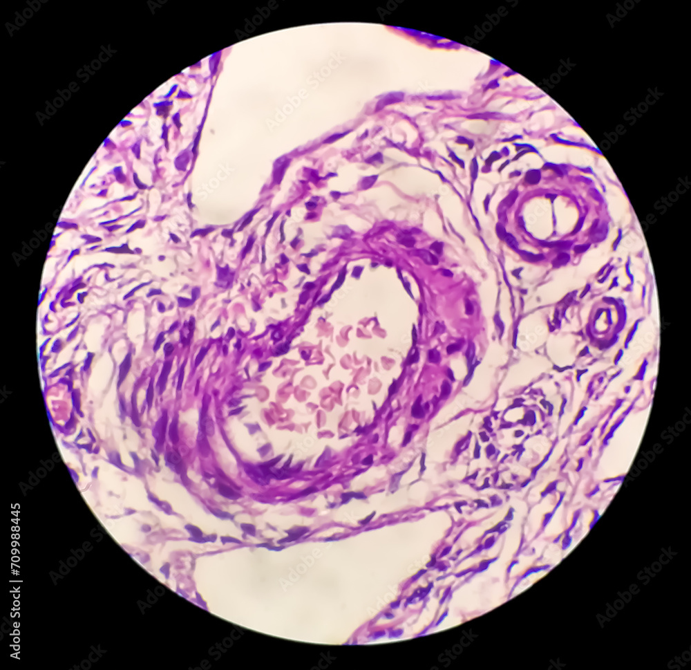 Poster Histology, Peritoneal inclusion cyst. Paraovarian cysts, hydrosalpinx and low-grade cystic mesothelioma are usually considered in the differential diagnosis of PICs.