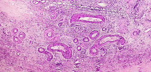 Histology, Peritoneal inclusion cyst. Paraovarian cysts, hydrosalpinx and low-grade cystic...