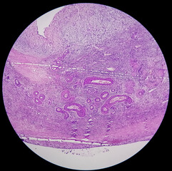 Histology, Peritoneal inclusion cyst. Paraovarian cysts, hydrosalpinx and low-grade cystic mesothelioma are usually considered in the differential diagnosis of PICs.