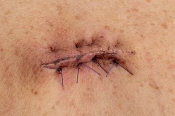 Dissolvable stitches applied following lipoma removal surgery, highly detailed shot