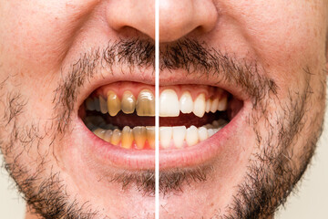 Close up of man's teeth before and after whitening and correction (braces, alignment). Oral care