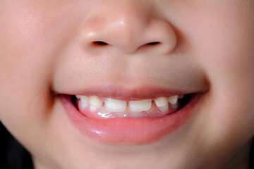 Close up of a cute Asian girl smiling happily showing her front teeth. Happy life concept