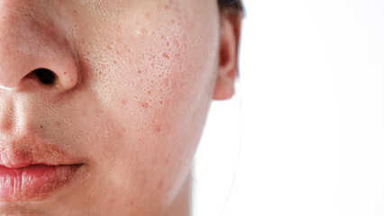 Asian face, Macro skin with enlarged pores. Allergic reaction, peeling, care for problem skin.