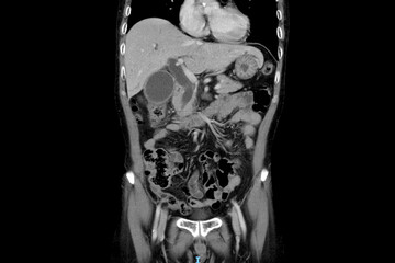Computer tomography scan technology in surgical patient with abdominal pain.Liver mass or tumor can...