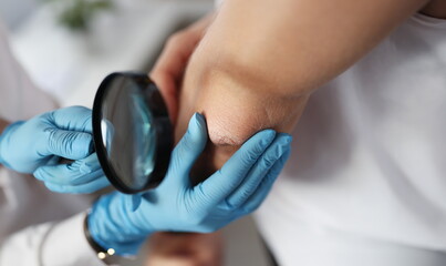 Dermatologist examines patient's hand through magnifying glass. Skin rashes and irritation concept - Powered by Adobe