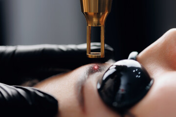 Laser removal of tattoo permanent makeup eyebrow of young woman in salon