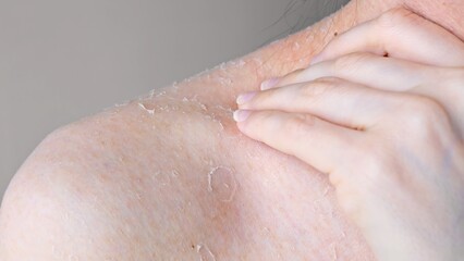 Fototapeta premium Skin problems on shoulder close-up effect of dehydration on problem skin dermatology and cosmetology shoulder is peeling scratching skin, concept of problem skin personal hygiene and health