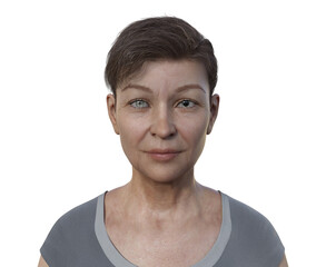 A woman with anisocoria, 3D illustration