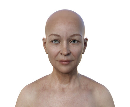 A woman with anisocoria, 3D illustration