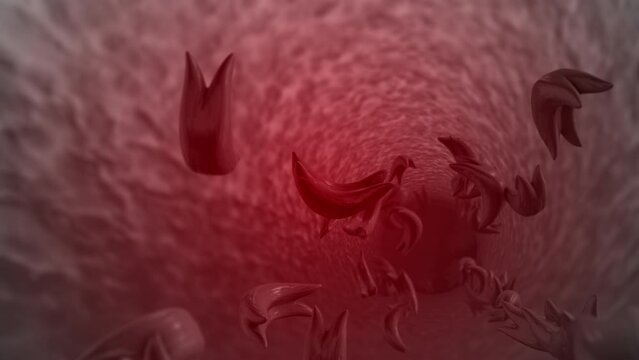 Sickle cells infection passing into the vein