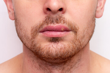 Obraz premium Close-up portrait of a Caucasian man with herpes on his lips. Manifestation of a viral infection in the form of vesicular ulcers. Decreased immunity or cold. Beauty and dermatology concept