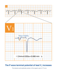 Fototapeta premium When the left atrium is abnormal, the absolute value of the duration and amplitude product of the negative part of lead V1 P-wave will increase, indicating dysfunction of the left atrium.