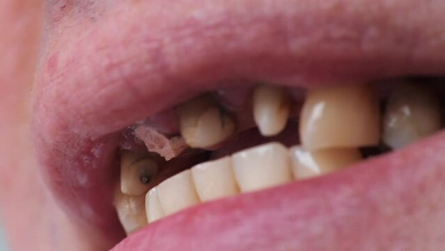 Broken tooth, missing teeth in open human mouth close up macro footage. Dental problems, dentistry medicine concept.