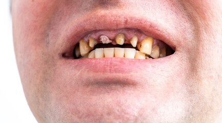 Periodontal disease, loose teeth in toothless man mouth, close up. Dental problems and orthodontic...