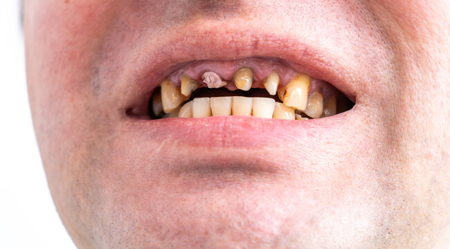 Periodontal disease, loose teeth in toothless man mouth, close up. Dental problems and orthodontic treatment for patient.