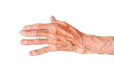 Rheumatoid polyarthritis of the hand of a 95 year old woman isolated on a white background.