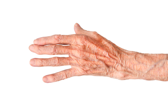 Rheumatoid polyarthritis of the hand of a 95 year old woman isolated on a white background.