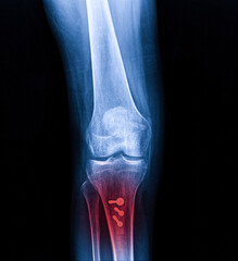 X-ray Knee Joint Fracture proximal tibia and Post fix fracture proximal tibia with plate and...