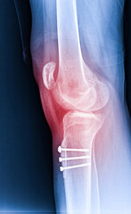 X-ray Knee Joint Fracture proximal tibia and Post fix fracture proximal tibia with plate and...