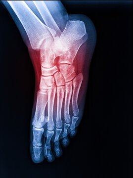 X-rays of the human foot, highlighted in red