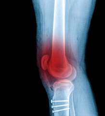 X-ray Knee Joint Fracture proximal tibia and Post fix fracture proximal tibia with plate and...