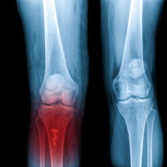 X-ray Knee Joint Fracture proximal tibia and Post fix fracture proximal tibia with plate and...