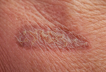 wound burn with cracks and peeling close-up on a person's hand