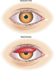 Medical illustration shows the comparison between a normal eye and one affected by trachoma an infectious disease caused by bacterium Chlamydia  trachomatis.